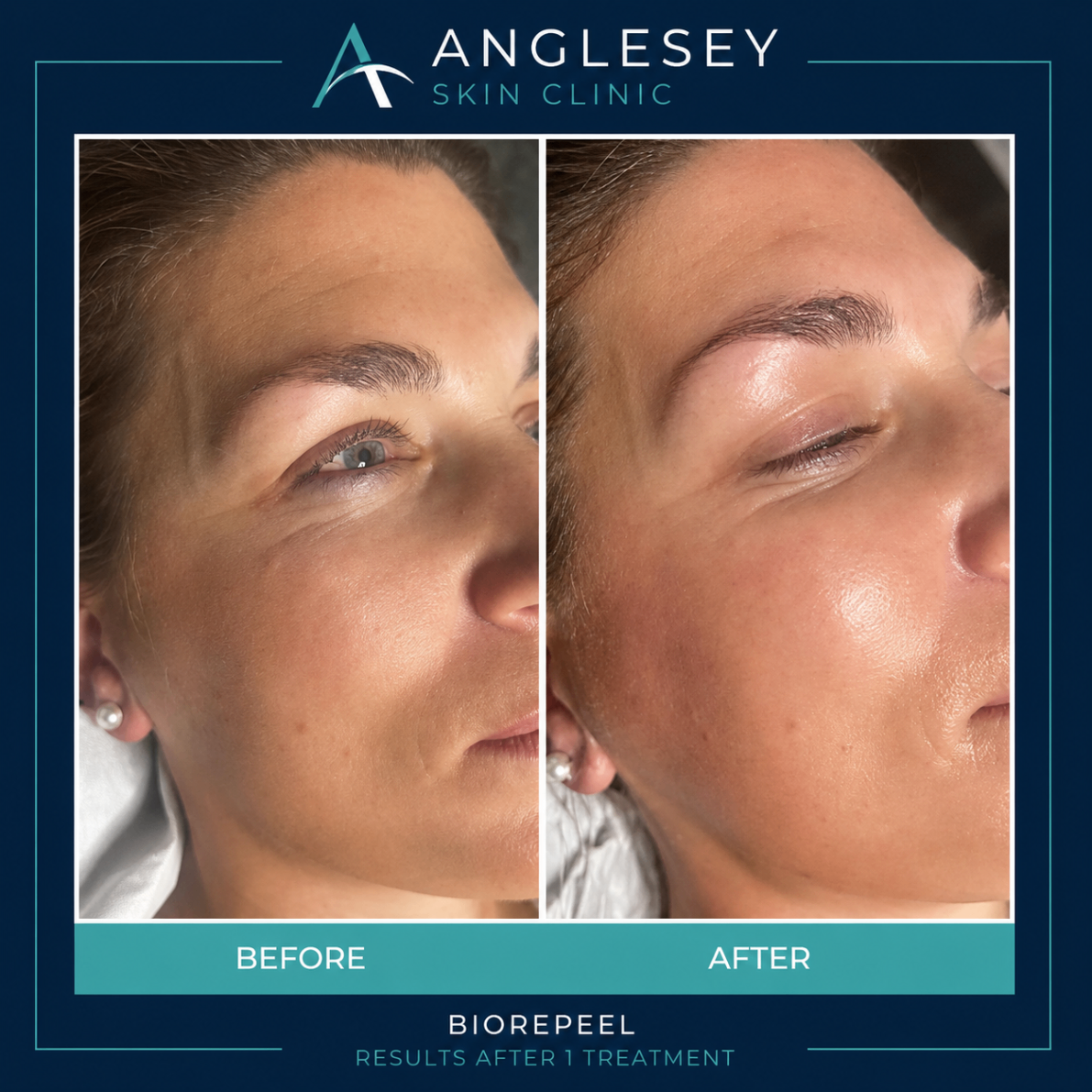 Biorepeel treatment result showing before and after skin improvement