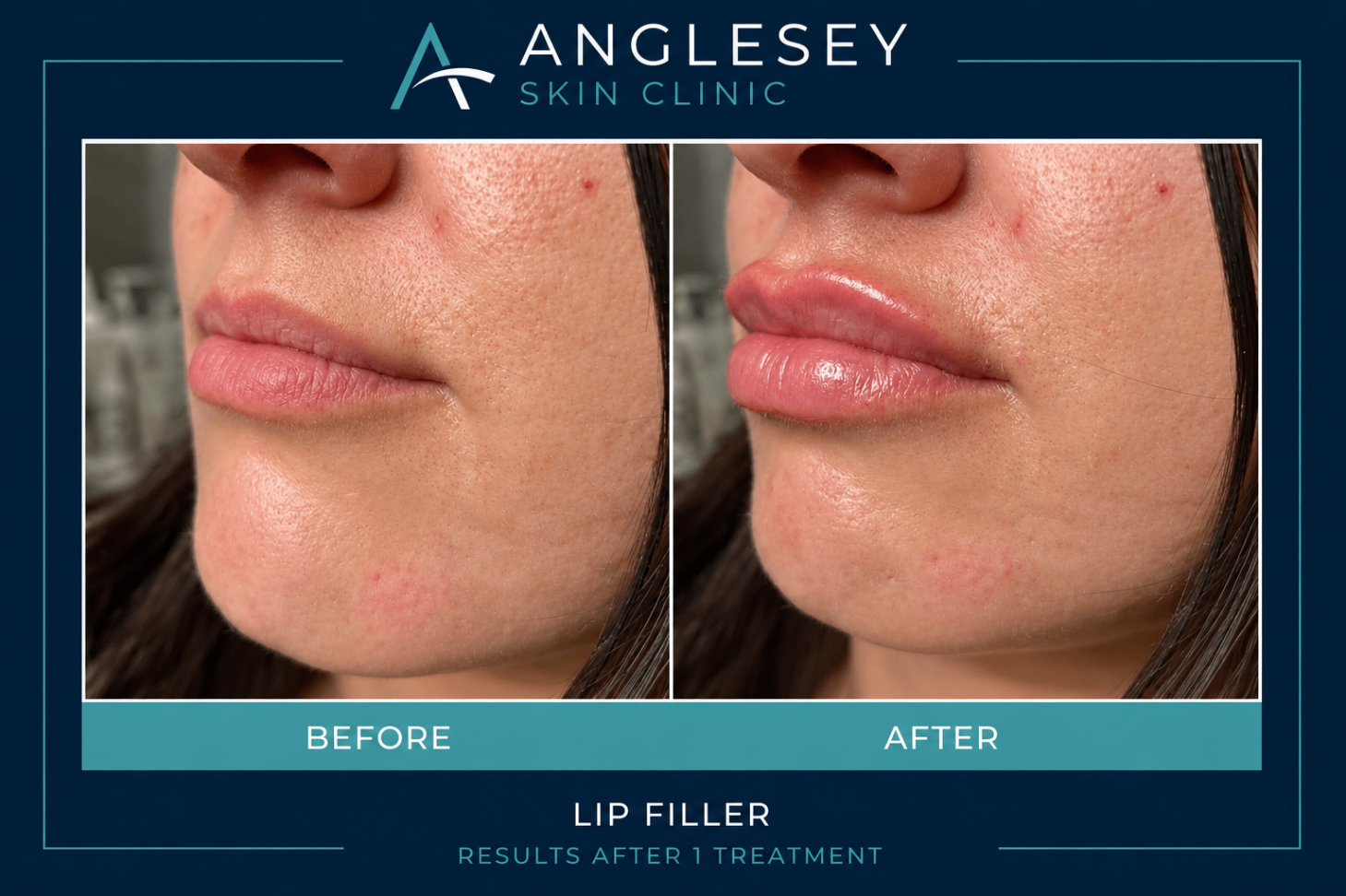Side profile lip filler result showing before and after volume enhancement