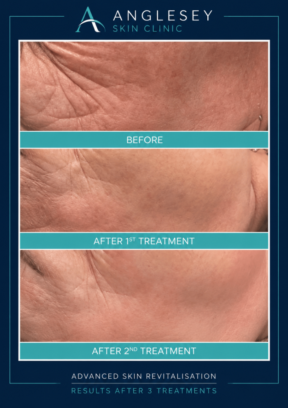 Advanced skin revitalisation result across a treatment series